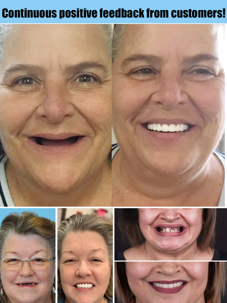 Custom Moldable Cosmetic Denture Set – Reusable Upper & Lower Jaw Solution