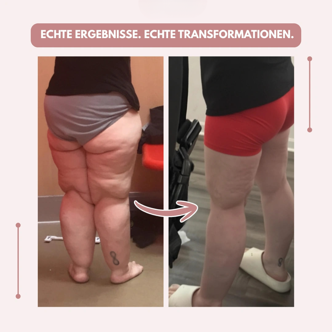Vorher-nachher-Vergleich der Beine einer Frau von hinten, rechts mit roter Shorts und glatterer Beinkontur. 10