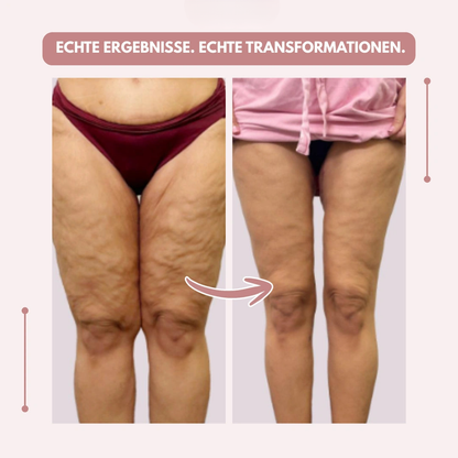 Vorher-nachher-Vergleich der Oberschenkel von vorn, links mit sichtbarer Hautstruktur, rechts glattere Beine unter einem rosa Shirt. 12