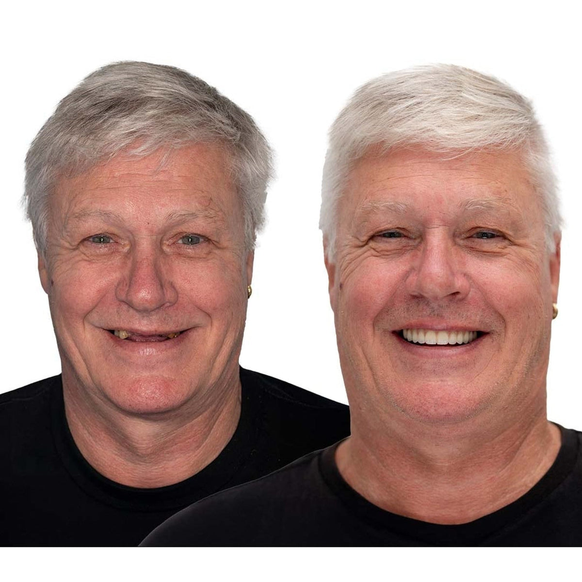 Vorher-nachher-Vergleich eines grauhaarigen Mannes im schwarzen Shirt: links mit Zahnlücken, rechts strahlend lächelnd mit vollständigem, gleichmäßigem Gebiss. 5